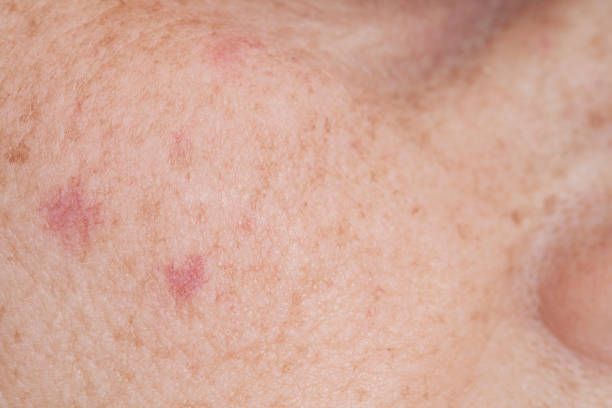 Close-up of skin with dark spots and blemishes, relevant to the topic of treatment for dark spots.