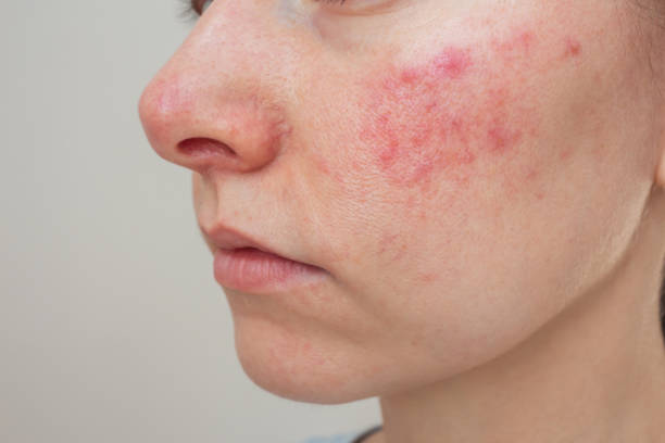 Holistic Approaches to Treating Acne and Skin Issues